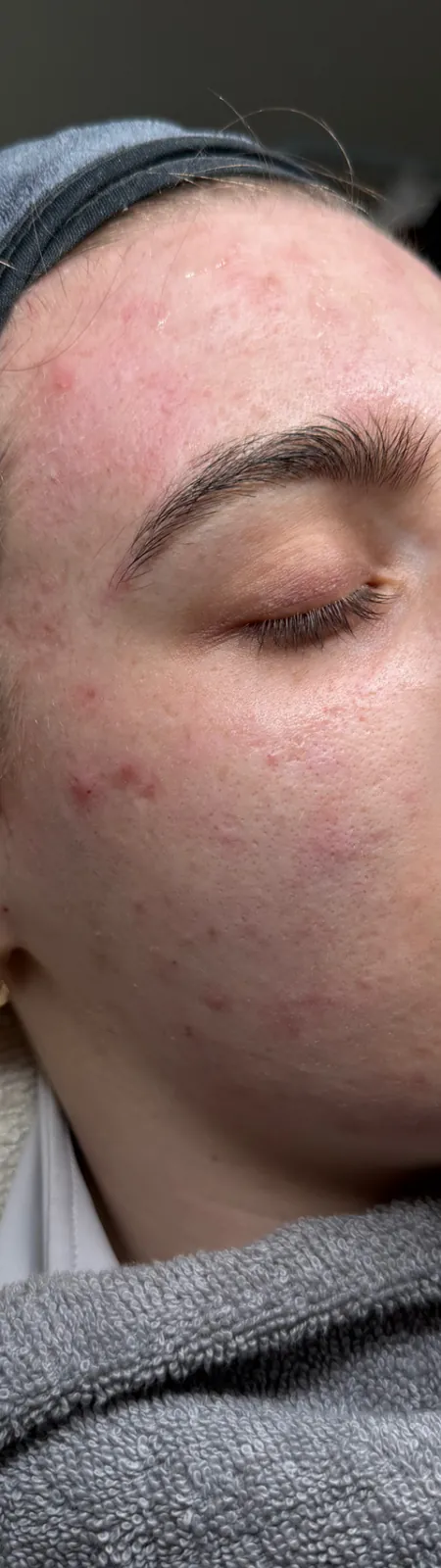 Skin with acne before treatment