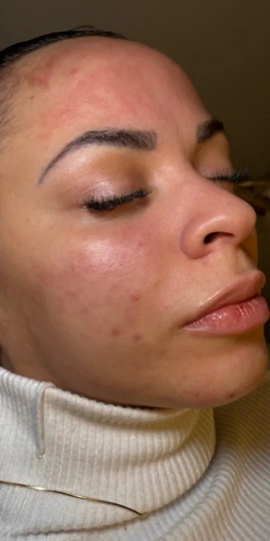 Skin with marks and redness before treatment
